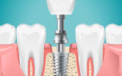 What Are the Benefits of Choosing Dental Implants in Siliguri at Dental Retreat Over Dentures?