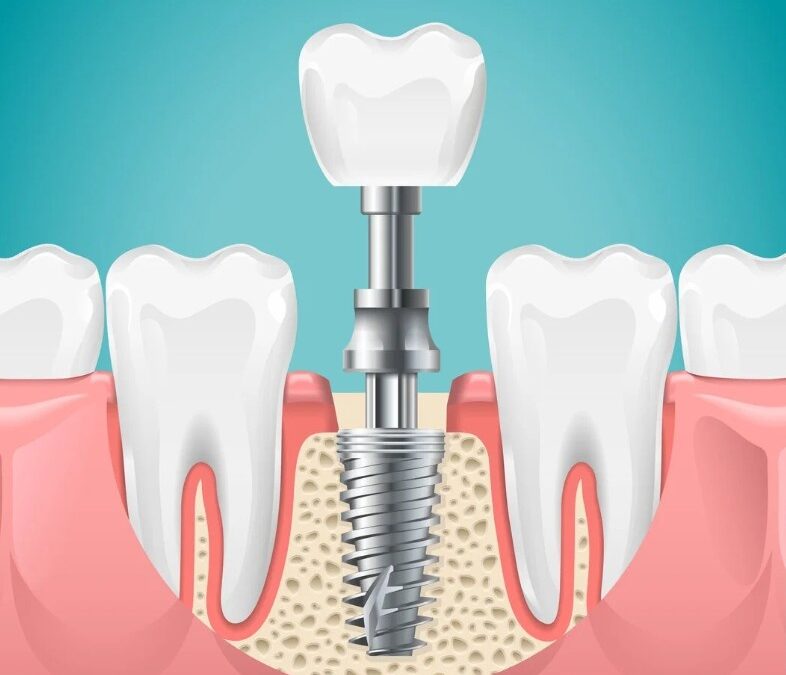 What Are the Benefits of Choosing Dental Implants in Siliguri at Dental Retreat Over Dentures?